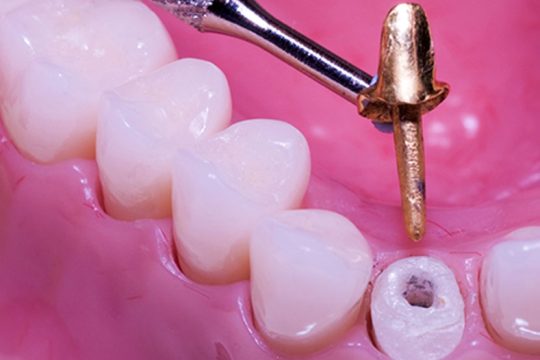 پست و کور دندان