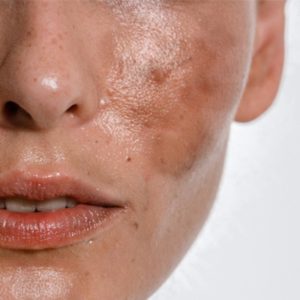 رفع لک و روشن سازی پوست