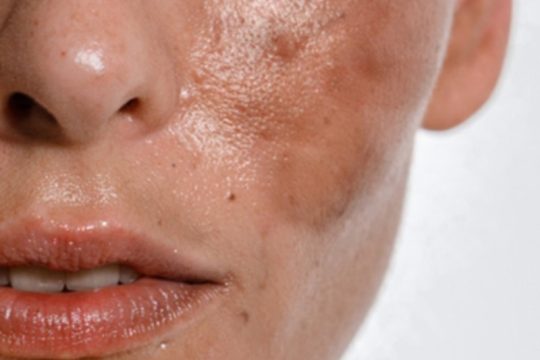 رفع لک و روشن سازی پوست