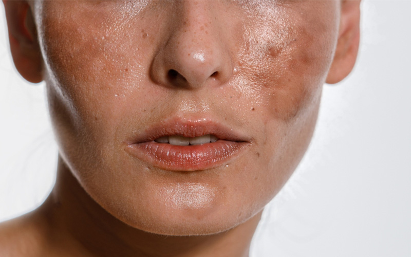 رفع لک و روشن سازی پوست