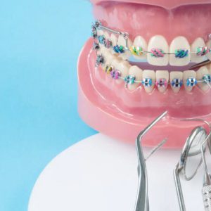تفاوت ارتودنسی ثابت، متحرک و نامرئی؛ کدام روش برای چه افرادی مناسب است؟