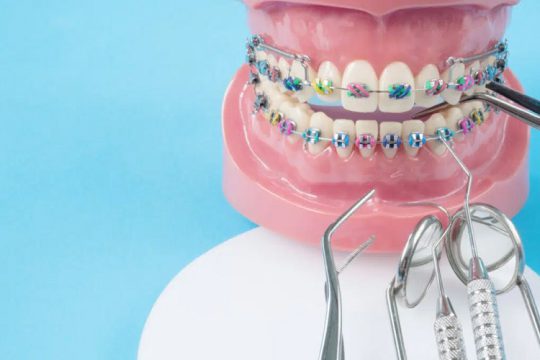 تفاوت ارتودنسی ثابت، متحرک و نامرئی؛ کدام روش برای چه افرادی مناسب است؟