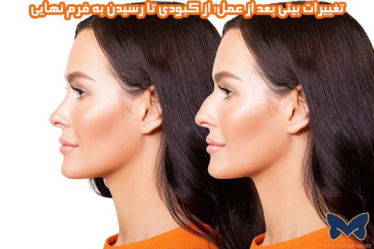 تغییرات بینی بعد از عمل؛ از کبودی تا رسیدن به فرم نهایی