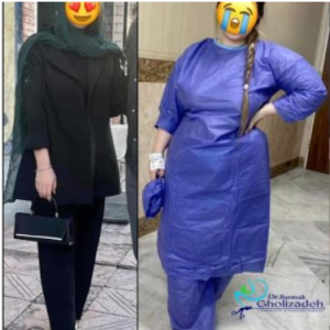 آیا بای پس معده تنها راه نجات از چاقی است؟