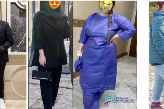 آیا بای پس معده تنها راه نجات از چاقی است؟