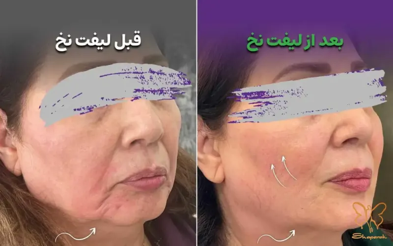 قبل و بعد از لیفت صورت با نخ