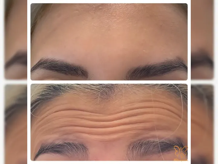 رفع چین وچروک صورت با تزریق بوتاکس
