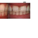 باندینگ دندان فاصله دار ؛ مراحل،مزایا، معایب و ماندگاری
