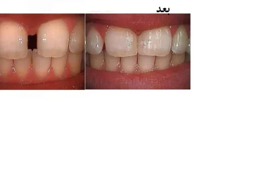 باندینگ دندان فاصله دار ؛ مراحل،مزایا، معایب و ماندگاری